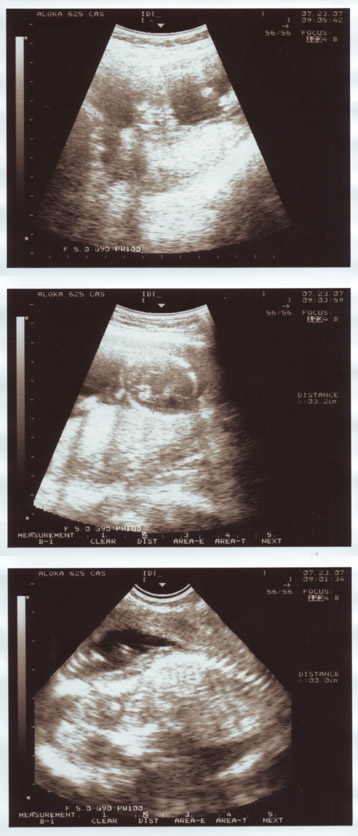 15 weeks pregnant. ultra sound 15 weeks pregnant